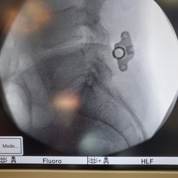 Mobin Neurosurgery - Later X-ray view post op, L4-L5 TLIF. - Neurologist Near Me - Beverly Hills, California