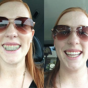 Jordan Lamberton, DDS MSD - Hello Ortho - Before and after photos - Orthodontists Near Me - Petaluma, California
