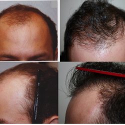 Surgical restoration