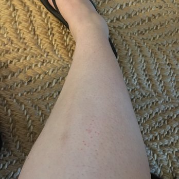 Village Nail Spa - The red little circles is where she almost burned me. - Nail Salons Near Me - Southern Pines, North Carolina Village Nail Spa - The red little circles is where she almost burned me. - Nail Salons Near Me - Southern Pines, North Carolina