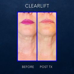 TruYou Body Renewal - Clear Lift Neck!