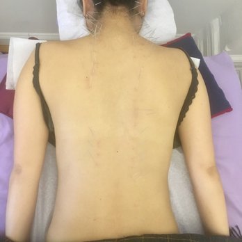 Hima Acupuncture - Manhattan - Archipancture treatment. - Acupuncture Near Me - New York, New York
