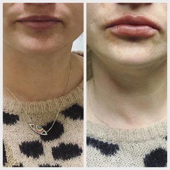 La Bella Laser & Slimming - Left (before) right (after Volbella) - Medical Spas Near Me - Arcadia, California La Bella Laser & Slimming - Left (before) right (after Volbella) - Medical Spas Near Me - Arcadia, California