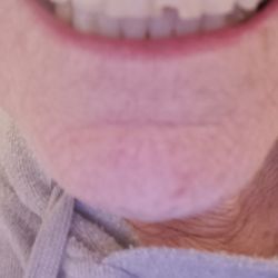 Fidler on the Tooth - Before