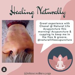 Natural Life Acupuncture & Holistic Medicine - Cupping with Natural Life Acu