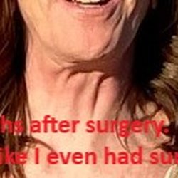 Daniel G Danahey, MD, PhD - 17 months after surgery. Still looks bad