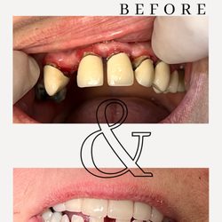 Keen Family Dentistry - Anterior Zirconia Crowns and Anterior Zirconia Bridge Completed by Dr. Bryce Keen