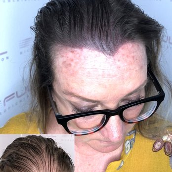 Full Micropigmentation - Before and after side - Hair Loss Centers Near Me - Las Vegas, Nevada Full Micropigmentation - Before and after side - Hair Loss Centers Near Me - Las Vegas, Nevada