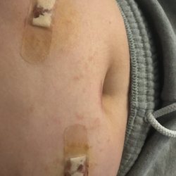Sentara Albemarle Medical Center - Elizabeth City - Rash not notated in medical notes