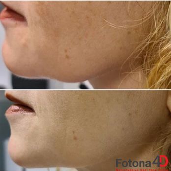 Anso Med Spa By ann + sofia - Fotona 4D results for sagging chin and jawline. - Skin Care Near Me - New York, New York