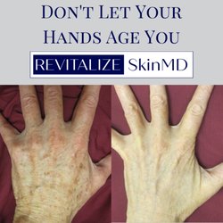 Revitalize SkinMD - BBL Sunspot Removal Before & After.