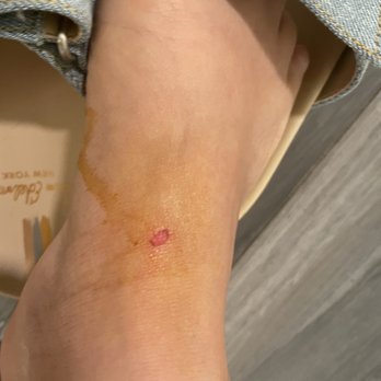 Sam Edelman - One of the wound that I got from this shoe, it hasn't healed for 4 days now - Shoe Stores Near Me - New York, New York Sam Edelman - One of the wound that I got from this shoe, it hasn't healed for 4 days now - Shoe Stores Near Me - New York, New York