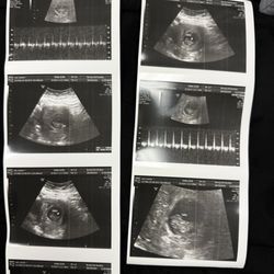Bump Life 4D Ultrasound Studio - Our printed sonogram with the heartbeat included! Peace of mind!