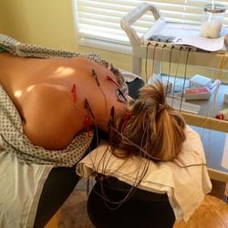 Bill Blakely Acupuncturist