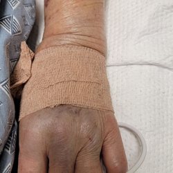 USC Cardio Vascular Thoracic Institute - Total negligent on the hospital's medical team. Knowing the patient is on blood thinner a few days prior and can bruise easily.