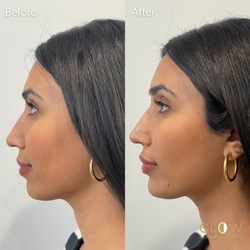 Chin filler