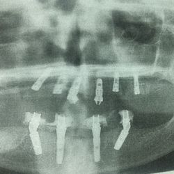 DDS Dentures + Implant Solutions of Denton - Posts are at different angles and depths one is straight out