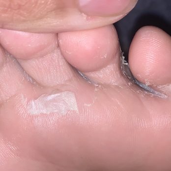Nails On Nails & Spa - My infected feet - Nail Salons Near Me - Whittier, California Nails On Nails & Spa - My infected feet - Nail Salons Near Me - Whittier, California