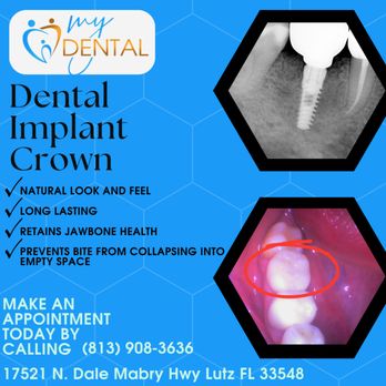 MyDental - Dental implant - General Dentistry Near Me - Lutz, Florida MyDental - Dental implant - General Dentistry Near Me - Lutz, Florida