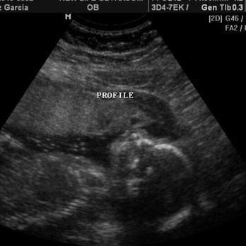 Zoi - Baby Roman at 20 weeks - Crisis Pregnancy Centers Near Me - Corona, California