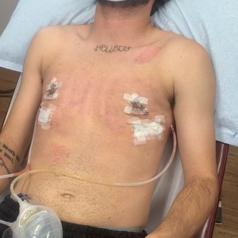 Alexander Sinclair, MD - Double mastectomy, top surgery, result photos. - Cosmetic Surgeons Near Me - Whittier, California