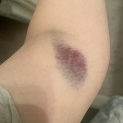 WestPac Labs - 2 days later - blown out vein.