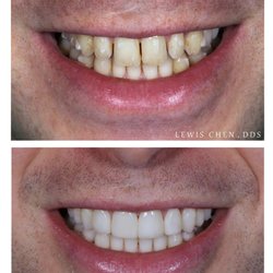 Advanced Dental Group - Invisalign & Veneer treatment