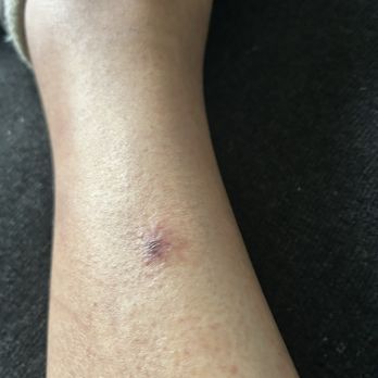 Cape Fox Lodge - I think a Bed bug bite - Hotels Near Me - Ketchikan, Alaska