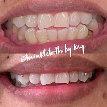 Twinkletooth By Kay - Teeth whitened and pink Swarovski gem and 18k Gold charm added - Teeth Whitening Near Me Twinkletooth By Kay - Teeth whitened and pink Swarovski gem and 18k Gold charm added - Teeth Whitening Near Me