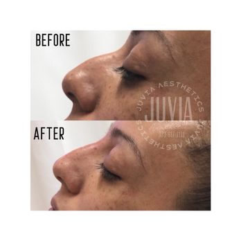 Juvia Aesthetics - Non-invasive nose enhancement by using fillers. - Skin Care Near Me - Wayne New Jersey, New Jersey