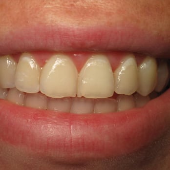 Greg Don, DDS - Before Cosmetic Filling - General Dentistry Near Me - Encino, California Greg Don, DDS - Before Cosmetic Filling - General Dentistry Near Me - Encino, California