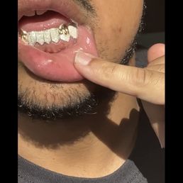 8 PIECE BOTTOM DIAMOND DUST WITH EXTENDED FANGS. 14k ROSE GOLD PLATED DRIP. CUSTOM PIECE 8 PIECE BOTTOM DIAMOND DUST WITH EXTENDED FANGS. 14k ROSE GOLD PLATED DRIP. CUSTOM PIECE