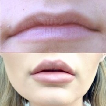 Advanced Aesthetics - Lips by the absolutely amazing, JEFF! - Medical Spas Near Me - Las Vegas, Nevada Advanced Aesthetics - Lips by the absolutely amazing, JEFF! - Medical Spas Near Me - Las Vegas, Nevada