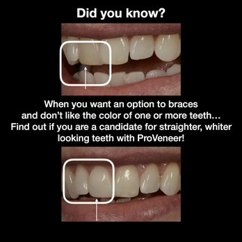 The Parker Skin & Aesthetic Clinic - Looking to fix the color of 1 tooth or have 1 uneven tooth and are thinking about an option to braces? 1 ProVeneer solved both problems! - Cosmetic Dentists Near Me - Beachwood, Ohio The Parker Skin & Aesthetic Clinic - Looking to fix the color of 1 tooth or have 1 uneven tooth and are thinking about an option to braces? 1 ProVeneer solved both problems! - Cosmetic Dentists Near Me - Beachwood, Ohio