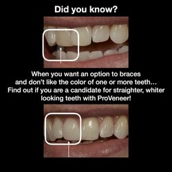 The Parker Skin & Aesthetic Clinic - Looking to fix the color of 1 tooth or have 1 uneven tooth and are thinking about an option to braces? 1 ProVeneer solved both problems!