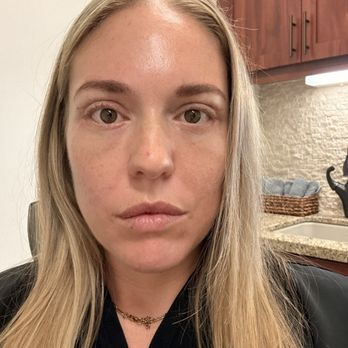 Cameron Francis M.D. - 3.5 weeks post upper and lower bleph - Plastic Surgeons Near Me - Del Mar, California
