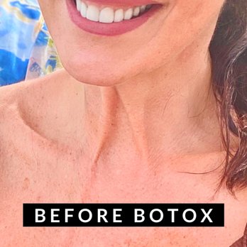 Pearl Med Spa - Before my Botox in neck bands . - Medical Spas Near Me - Boca Raton, Florida Pearl Med Spa - Before my Botox in neck bands . - Medical Spas Near Me - Boca Raton, Florida