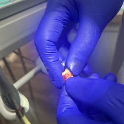 Dental Arts of Sayville - Extracted tooth