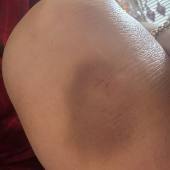 Reveler’s Hour - My knee after I fell... Still hurts .... - Italian Near Me - Washington, DC, District of Columbia