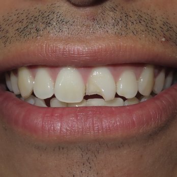 Toothopia Dental - Before procedure; chipped it badly playing rough with my buddy lol. - Orthodontists Near Me - Culver City, California