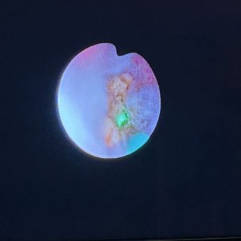 Regional Urology - Kidney stone - Urologists Near Me - Shreveport, Louisiana Regional Urology - Kidney stone - Urologists Near Me - Shreveport, Louisiana