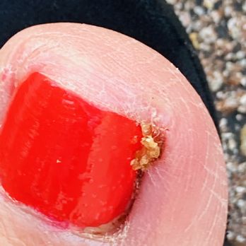Ocala Nail Salon - Crusted toenail. - Nail Salons Near Me - Ocala, Florida
