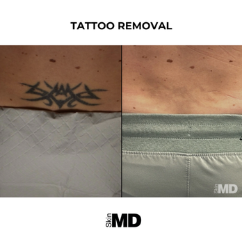 SkinMD - No more regrets -- the Genesis laser is the #1 solution for tattoo removal in the Boston area at Skin MD. - Skin Care Near Me - Hyannis, Massachusetts SkinMD - No more regrets -- the Genesis laser is the #1 solution for tattoo removal in the Boston area at Skin MD. - Skin Care Near Me - Hyannis, Massachusetts