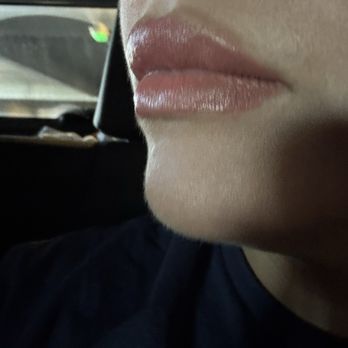 LA Tox Medspa - Lip filler - Aestheticians Near Me - Downey, California