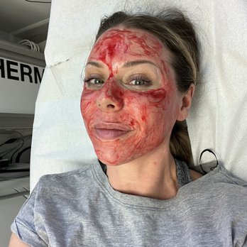 Korman Plastic Surgery & Wunderbar MedSpa - PRP facial! Aka "Vampire Facial" - Cosmetic Surgeons Near Me - Mountain View, California