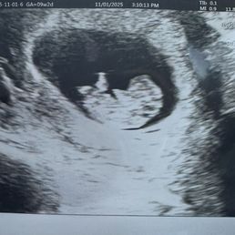 Baby at 9weeks! Baby at 9weeks!