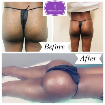 Smooth Body Contours - Sculptra Brazilian Butt Lift - Body Contouring Near Me - Orlando, Florida