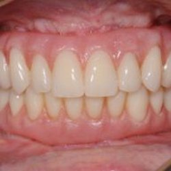 Jung Dental Implant Center - All-on-four implants case