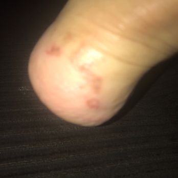 Nails M Spa - Blistered skin after pedicure. - Waxing Near Me - Long Beach, California Nails M Spa - Blistered skin after pedicure. - Waxing Near Me - Long Beach, California