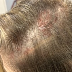 Lena Hair Salon - Scalp blisters
